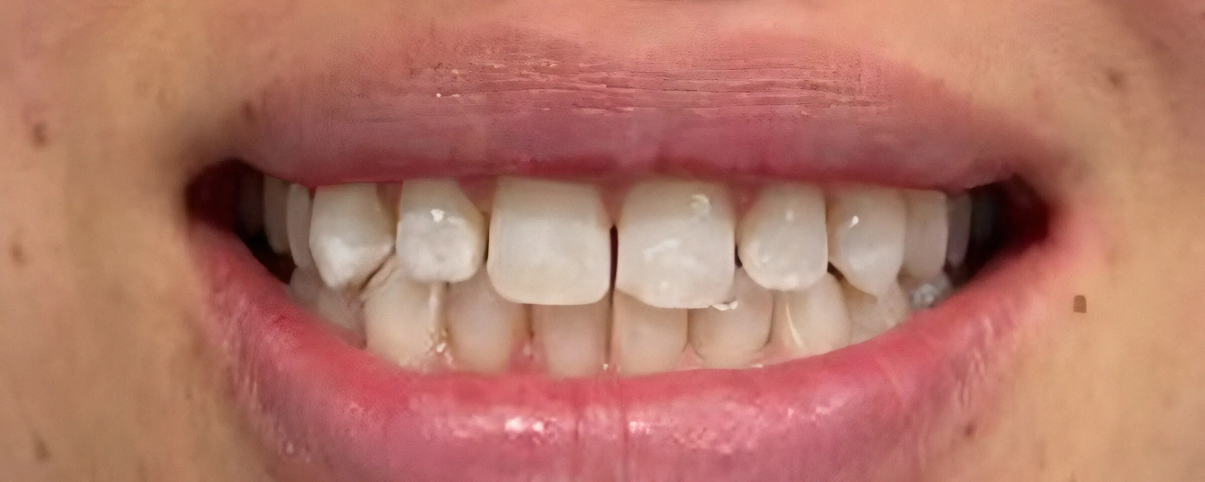 Sonrisa antes del blanqueamiento, con dientes de tono amarillento