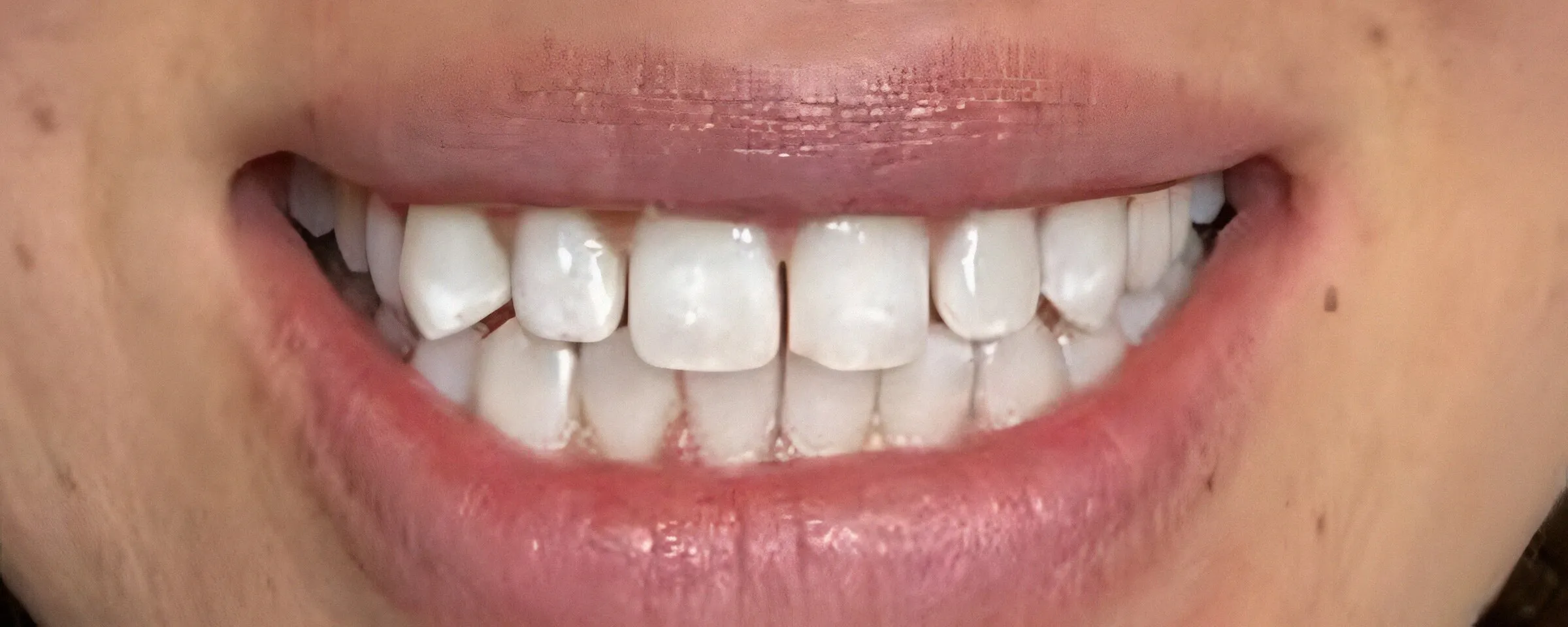 La misma sonrisa después del blanqueamiento, con dientes más blancos